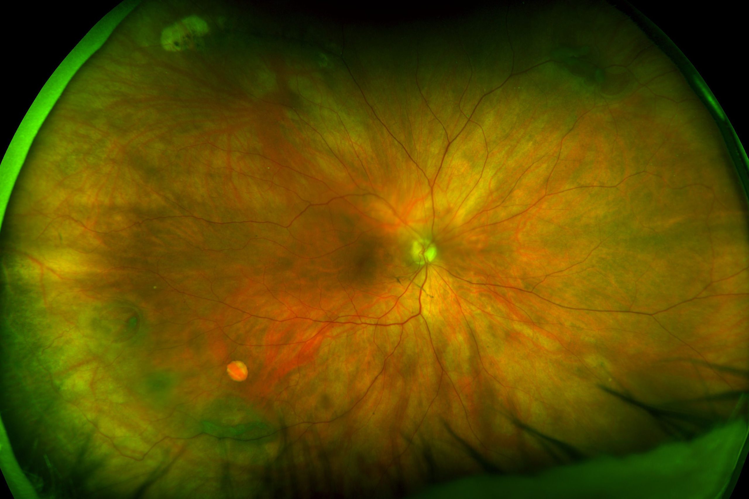 Color Retinal Hole scaled