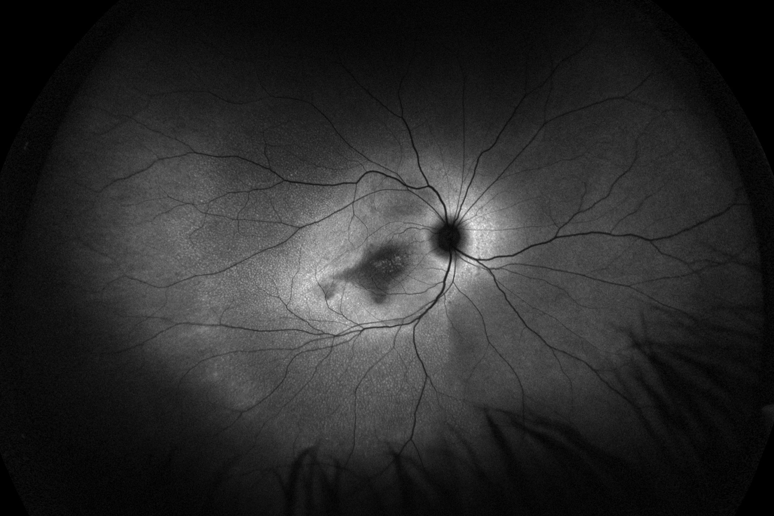 Macular Dystrophy scaled